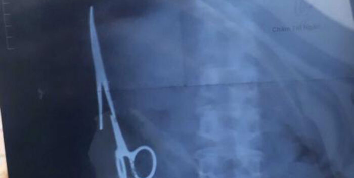Hombre murió en Zulia porque le dejaron una tijera en el estómago tras cirugía
